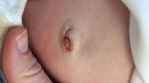 ống niệu rốn