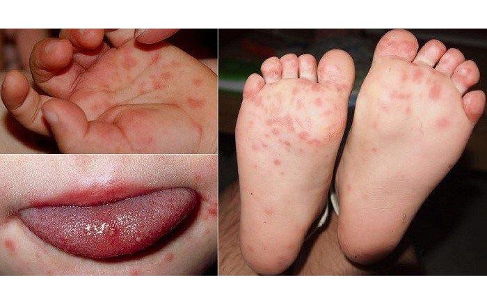 Acyclovir không có tác dụng đặc hiệu trong điều trị bệnh tay chân miệng