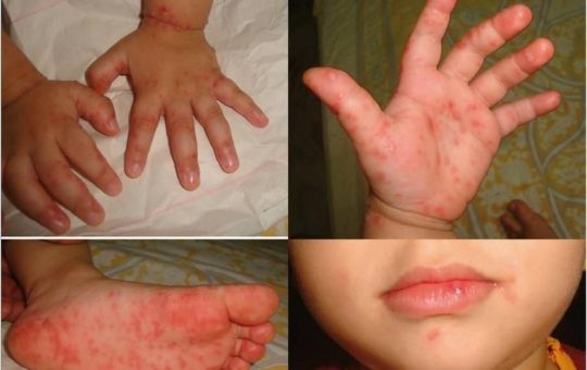 Tay chân miệng có thể dẫn đến biến chứng nguy hiểm,