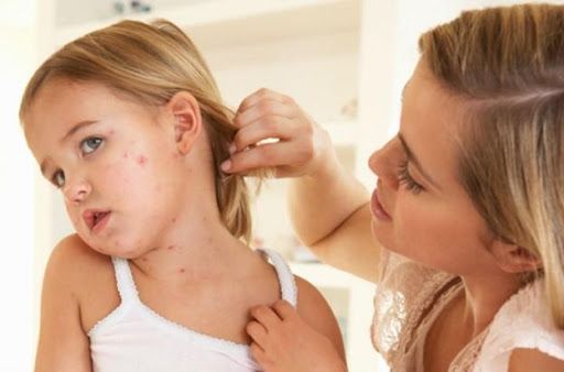 Cách chăm sóc da đúng khi tay chân miệng