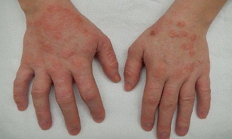 Dấu hiệu viêm da cơ địa ở trẻ em theo từng giai đoạn